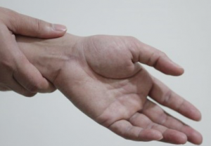 Carpel-Tunnel